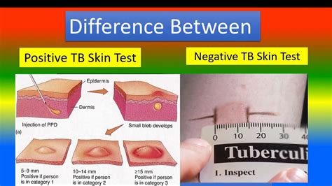 what does a positive tb test look like|TB Skin Test: Uses, Procedure, and Results.